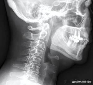 男子中午吃一条鱼 下午上班死亡 小鱼刺引发大悲剧