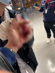 男子称3根手指被机场扶梯传送带夹伤 治疗费用成难题