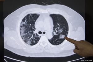 这样的结节更危险 关键看“行为”