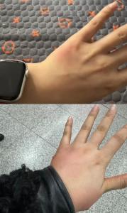 女子火车硬卧遭虫咬 左手肿如馒头 赔偿协商未果