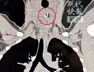 11岁男孩误吞鱼钩医生手术取出