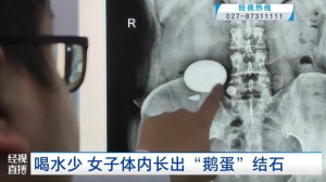 女子不爱喝水长巨型肾结石 罕见病例警示多饮水的重要性