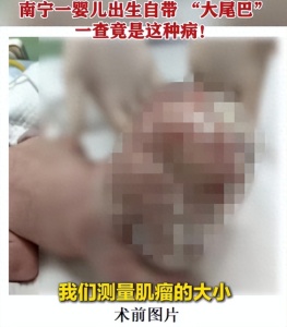 婴儿出生自带直径13厘米“大尾巴” 顺利手术后出院