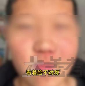 男孩智齿长到“眼窝”里 罕见案例引发关注