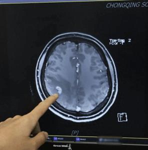 女子多年肢体麻木开颅抓出3厘米活虫！