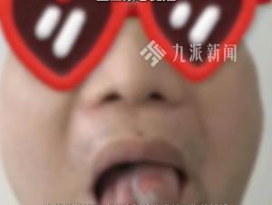 男子舌头长疙瘩以为上火结果是舌癌 小疙瘩竟是恶性肿瘤