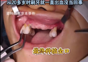 男子掉14颗牙剩下14颗也得全拔掉 医生：每天两包烟，血糖控制得也不好