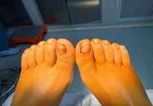 26岁女子穿袜子睡觉睡出千层甲 袜子惹的祸