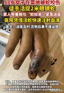 53岁阿姨被眼镜蛇咬伤后 徒手擒蛇 冷静自救教科书