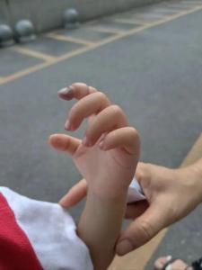 2岁女童手指发紫近36小时险截指 橡皮筋成隐形杀手