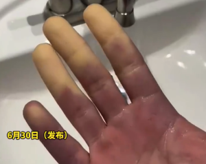 空调开23度 男子睡梦中手指莫名又冷又麻惊醒