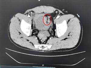 男子酒后摔跤致膀胱裂开10cm 酒精利尿增加风险