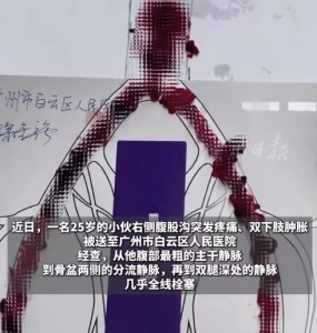 25岁小伙腹部到腿部的血管几乎堵死 医生‌手术取出大量血栓‌目前恢复良好