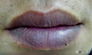 嘴唇发紫需要注意哪些问题 警惕心肺健康信号