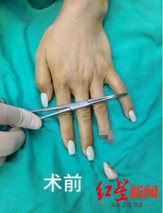 女子因美甲導(dǎo)致手指感知失靈被夾斷 厚實(shí)美甲成“元兇”