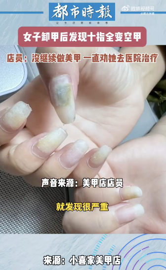 卸甲后发现指甲发霉 美甲隐患引警觉