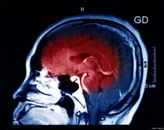 这种头痛小心是癌症信号 警惕颅内定时炸弹