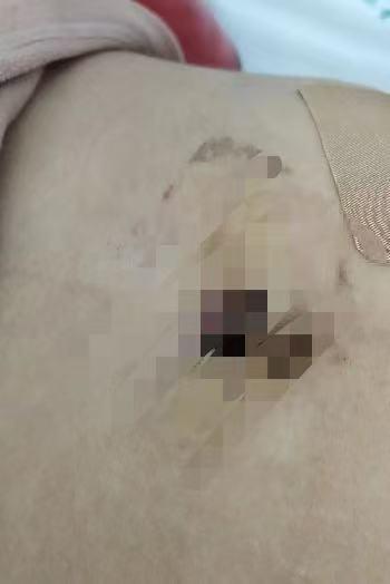 视频 女子取环手术后被鉴定为十级伤残 两年维权路艰难