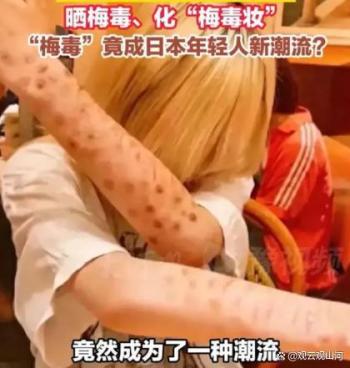 日本梅毒患者超1.3万 感染人数持续高位