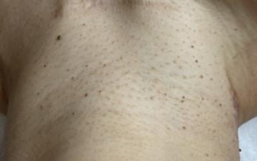 注意！脖子上的“小肉球”可能是HPV感染 脖子上长的小肉球到底是什么东西？ 