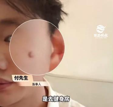 撸铁后挠脸 男子脸上长出“小肉球”