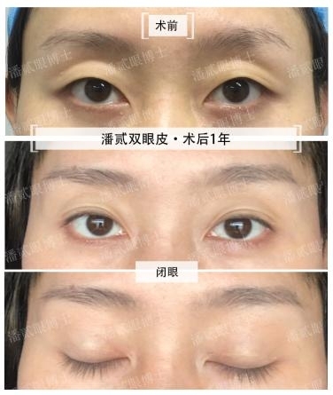 潘贰耗时7年著成眼整形决策工具书《一目了然·双眼皮成形术及“失败”修复全攻略》