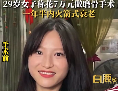 29岁女子称7万元做磨骨后火箭式衰老：面部下垂法令纹明显