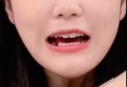 23岁女生拔掉57颗牙的体验！