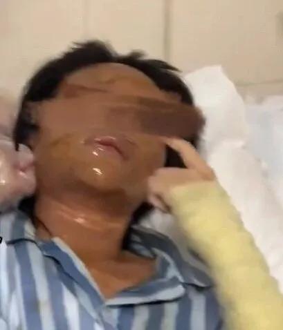 湖南一主播被伪装成快递的炸弹包裹炸伤,面部达深二度烧伤 疑因个人矛盾遭报复