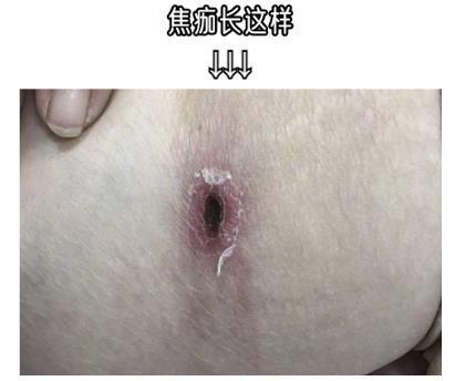 已有人中招！女子“呼吸衰竭高烧不退 “真凶”竟是它