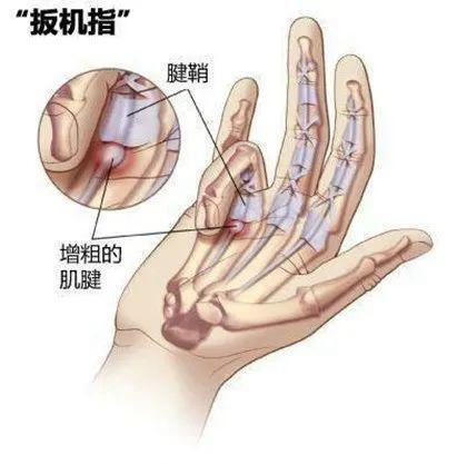 男子长期刷手机右手变成“扳机指” 警惕手指“罢工”信号