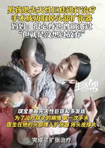 男孩患巨痣手術(shù)后成功取掉擴(kuò)張器