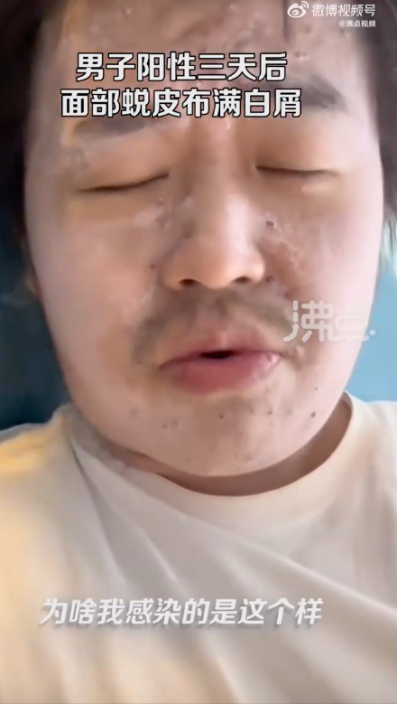 男子阳性3天后面部蜕皮布满白屑
