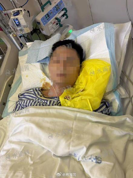 海南3人吃癞蛤蟆中毒致1死