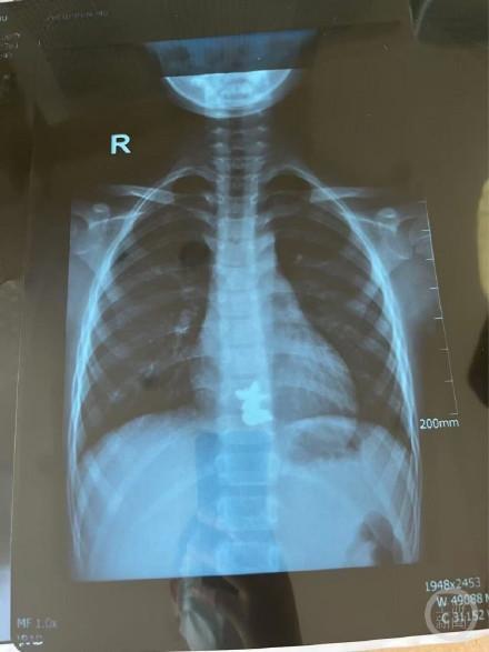 男孩吞服2枚磁鐵致4處腸穿孔 緊急手術(shù)挽救生命