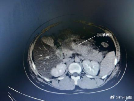 医生回应14岁少年暴食被下病危通知 急性胰腺炎需警惕