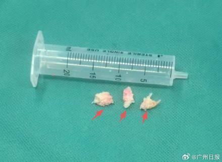 男子肩痛自行使用按摩仪后瘫痪 不当按摩加重颈椎病