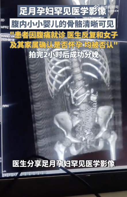 医生分享足月孕妇罕见的医学影像