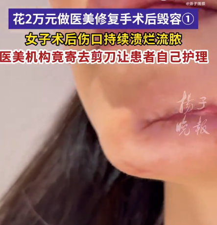女子医美后伤口溃烂留疤被分手 机构寄刀让自行护理