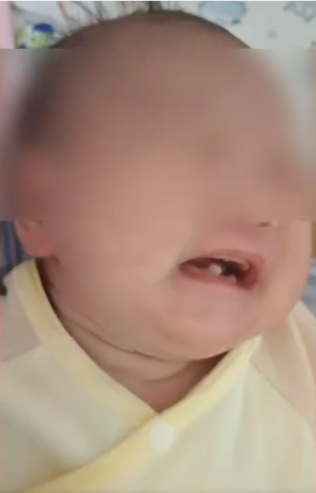 早产儿出生就长2颗牙被拔掉 医生：怕宝宝呛到气管
