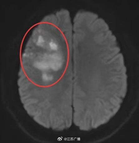 29岁230斤小伙一觉醒来突发脑梗