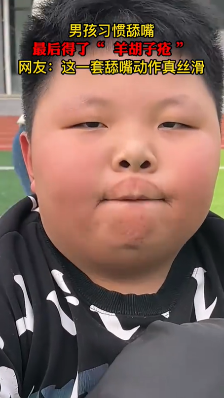 男孩习惯性舔嘴唇患上“羊胡子疮”