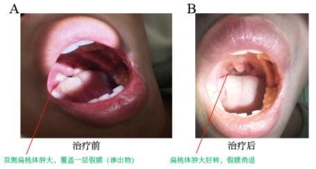 男子高热咽痛患上亲吻病