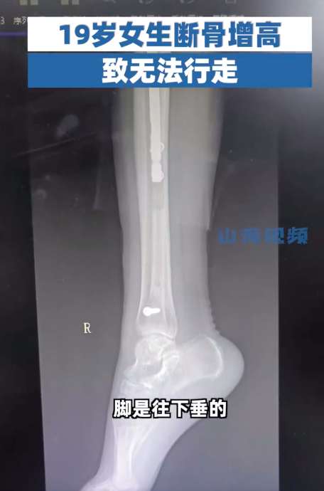 19岁女生断骨增高后无法行走！断骨增高四个字听起来不可怕吗