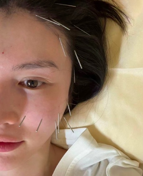 何穗做了面部提升针灸 自然抗衰新方式