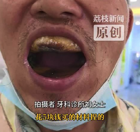男子网购5元树脂自行补牙致口腔变形 诊所医院不敢动称难处理