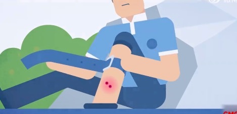 轉(zhuǎn)發(fā)提醒！被蛇咬后如何快速處理