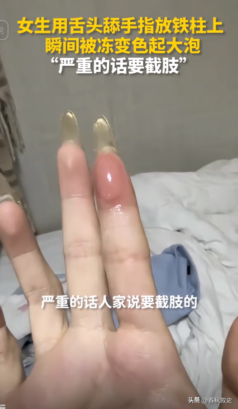 女子在漠河手指蘸口水摸铁被冻伤 好奇尝试代价惨痛