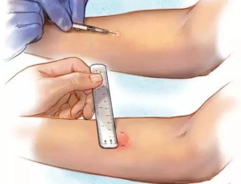 山东宁阳县4岁男童在药店打针后去世 皮试缺失酿悲剧