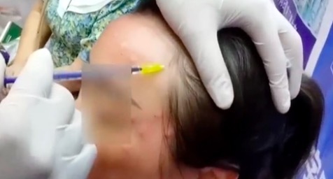 3·15第二弹！曝光不可注射的美容针！妆字号美容针或致毁容 医疗美容是很专业的事情！